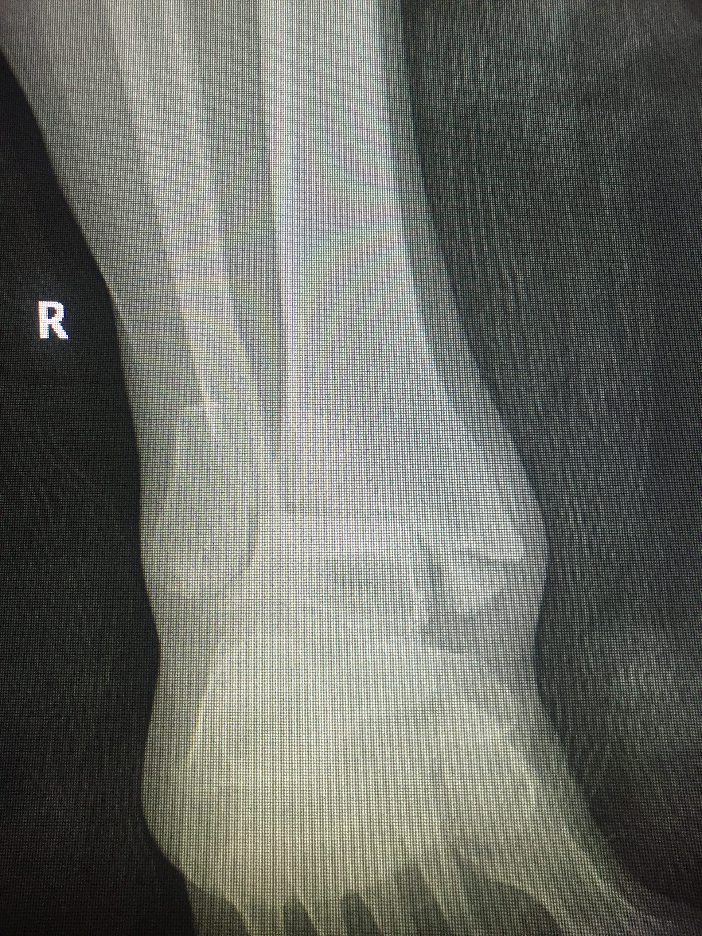 Ankle Fracture PreOp – Dr. Richard Zell